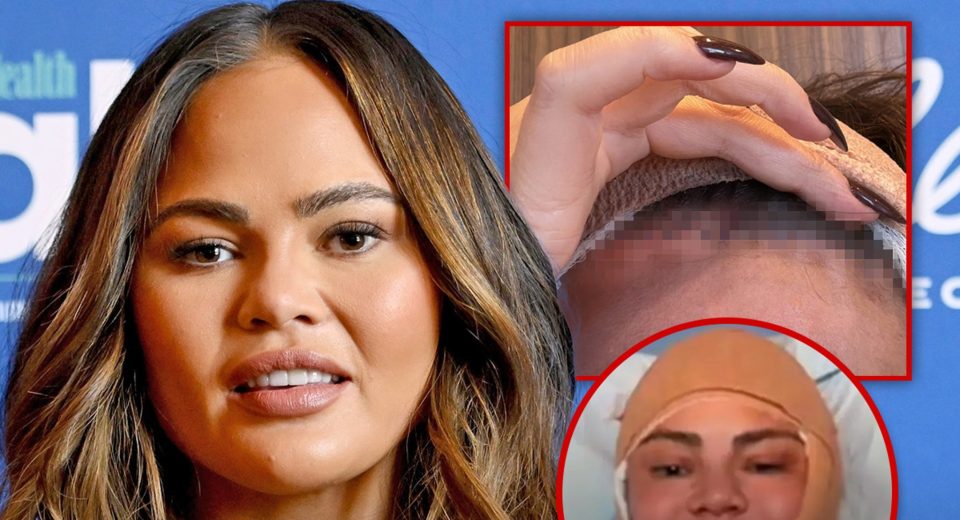Chrissy Teigen apela a um rosto esticado após a cirurgia